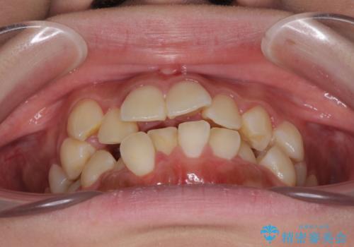 インビザラインが続けられない　ワイヤー矯正での抜歯矯正　その1の治療前