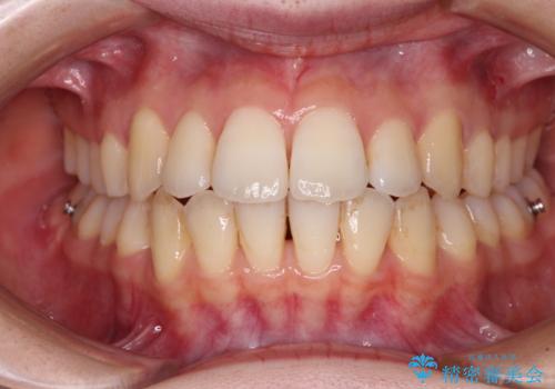 【モニター】前歯の前突感とクロスバイトをインビザラインで改善の治療中