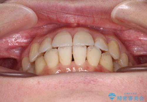 【モニター】前歯の前突感とクロスバイトをインビザラインで改善の治療中