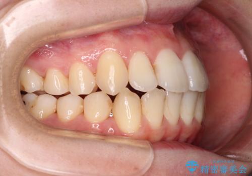 【モニター】前歯の前突感とクロスバイトをインビザラインで改善の治療中