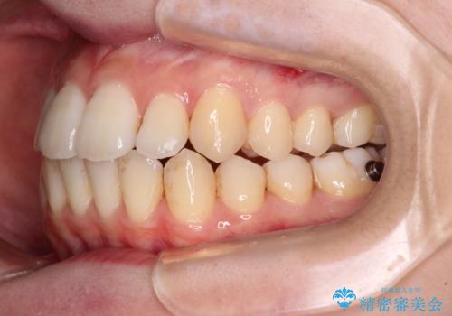 【モニター】前歯の前突感とクロスバイトをインビザラインで改善の治療中