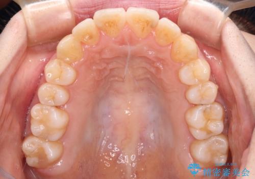 【モニター】前歯の前突感とクロスバイトをインビザラインで改善の治療中
