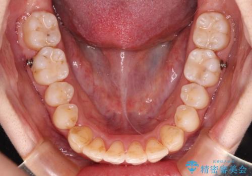 【モニター】前歯の前突感とクロスバイトをインビザラインで改善の治療中