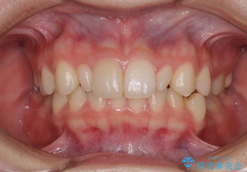 【モニター】ワイヤー矯正で手っ取り早く治療の症例 治療前