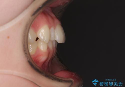 【モニター】ワイヤー矯正で手っ取り早く治療の治療前