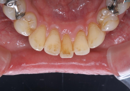 2カ月に1回の着色落とし(PMTC)の治療前
