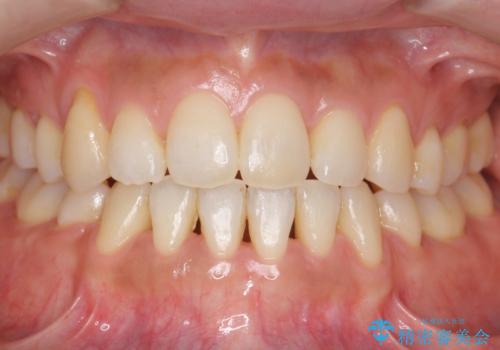 八重歯　上下の正中のずれ　40代で抜歯矯正の症例 治療後