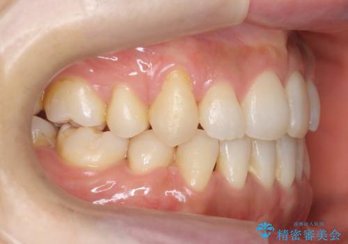 八重歯　上下の正中のずれ　40代で抜歯矯正の治療後
