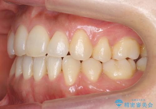 八重歯 上下の正中のずれ 40代で抜歯矯正の治療後