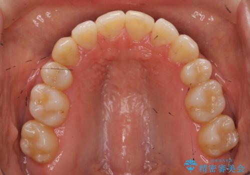 八重歯 上下の正中のずれ 40代で抜歯矯正の治療後