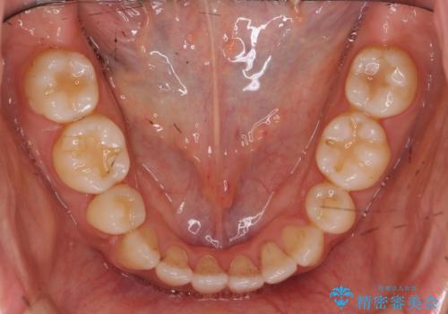 八重歯 上下の正中のずれ 40代で抜歯矯正の治療後