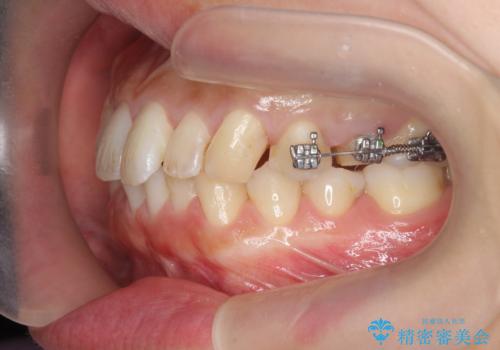 挺出小矯正を行った縁下カリエス治療の治療前