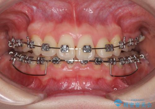 上顎のみの抜歯矯正　前歯のデコボコを改善するの治療中