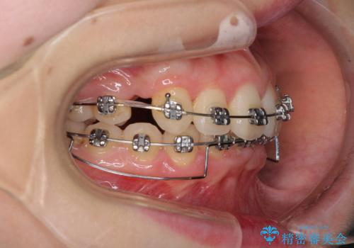 上顎のみの抜歯矯正 前歯のデコボコを改善するの治療中