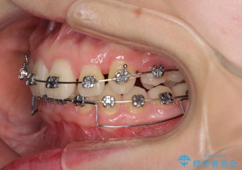 上顎のみの抜歯矯正 前歯のデコボコを改善するの治療中