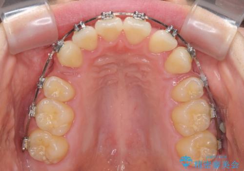 上顎のみの抜歯矯正 前歯のデコボコを改善するの治療中