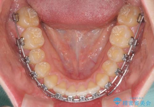 上顎のみの抜歯矯正 前歯のデコボコを改善するの治療中
