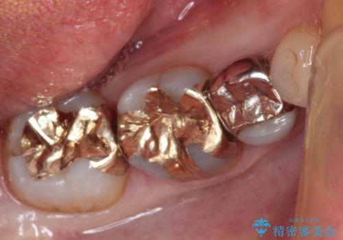下の奥歯の虫歯をゴールドインレーで治療の治療後