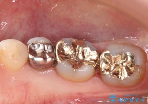 下の奥歯の虫歯をゴールドインレーで治療の症例 治療後