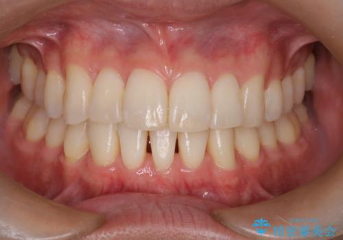 前歯の重なりとガタガタをマウスピースで改善した症例の症例 治療後