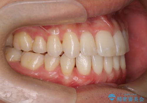 前歯の重なりとガタガタをマウスピースで改善した症例の治療後