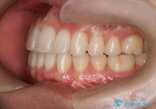 前歯の重なりとガタガタをマウスピースで改善した症例の治療後
