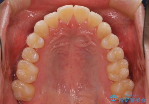 前歯の重なりとガタガタをマウスピースで改善した症例の治療後