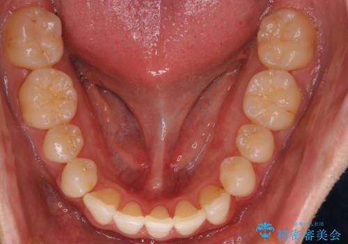 前歯の重なりとガタガタをマウスピースで改善した症例の治療後