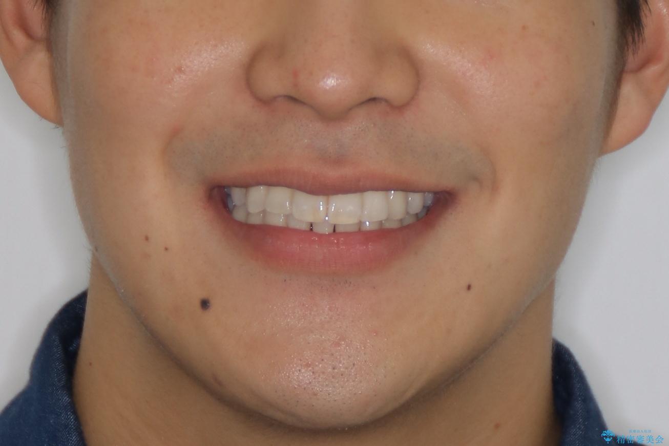 前歯の重なりとガタガタをマウスピースで改善した症例の治療後（顔貌）