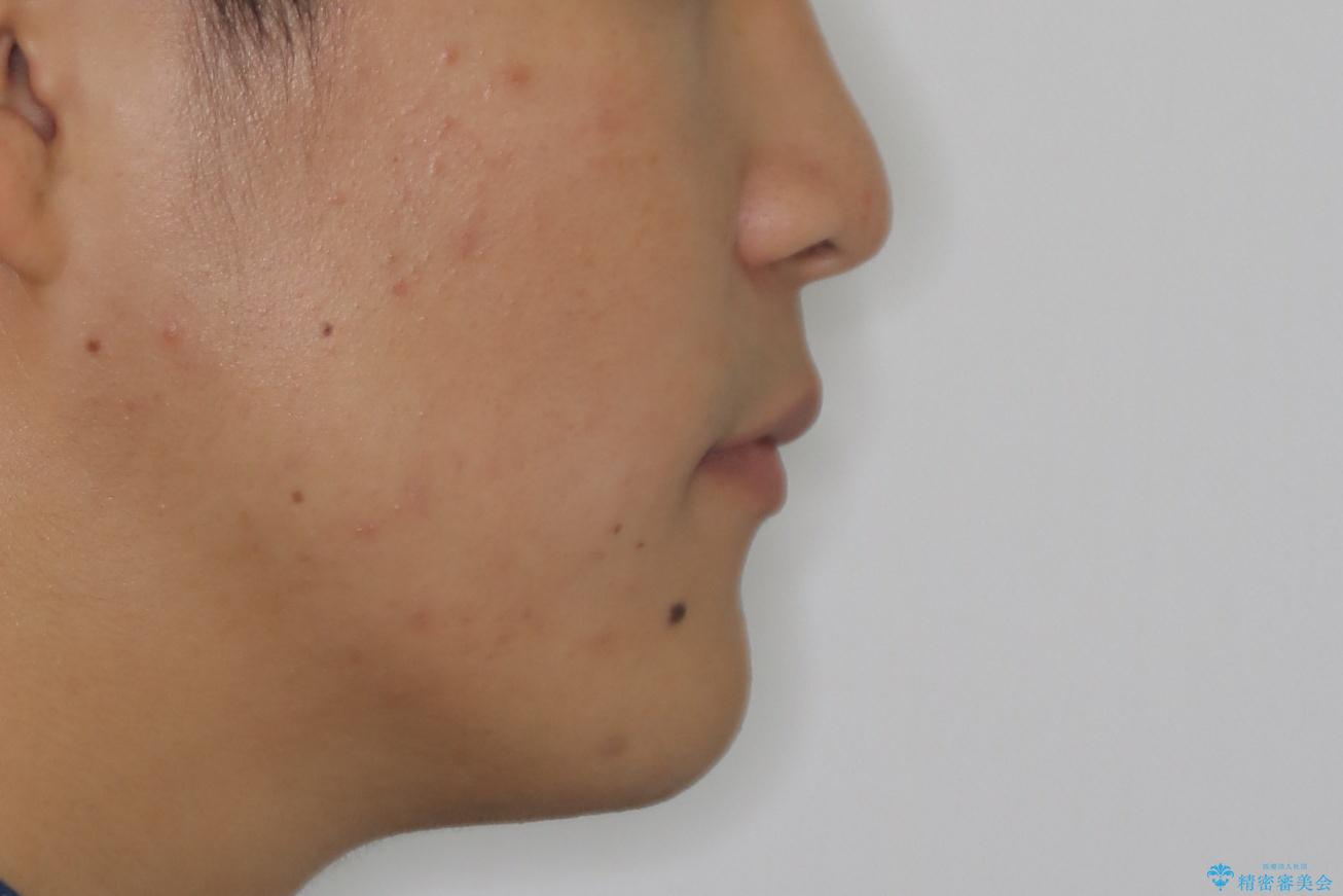 前歯の重なりとガタガタをマウスピースで改善した症例の治療後(顔貌)