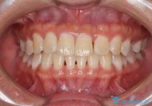 前歯の隙間と上下正中のズレを解消の症例 治療前