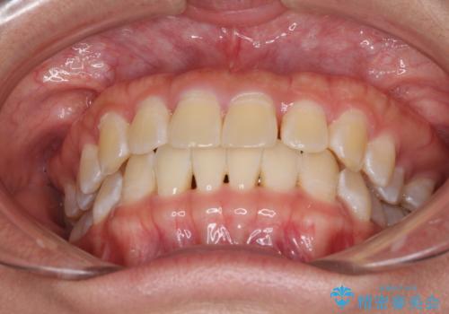前歯の隙間と上下正中のズレを解消の治療前