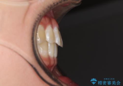 前歯の隙間と上下正中のズレを解消の治療前