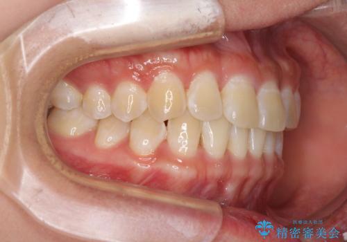 前歯の隙間と上下正中のズレを解消の治療前