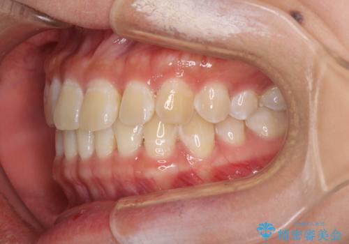 前歯の隙間と上下正中のズレを解消の治療前