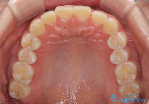 前歯の隙間と上下正中のズレを解消の治療前