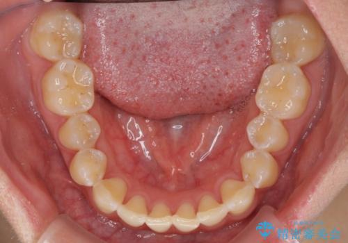 前歯の隙間と上下正中のズレを解消の治療前