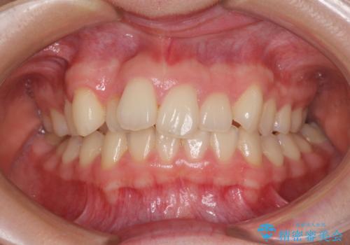 上顎のみの抜歯矯正　前歯のデコボコを改善するの治療前