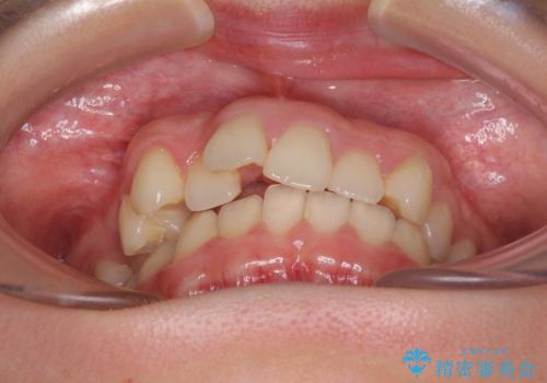 上顎のみの抜歯矯正 前歯のデコボコを改善するの治療前