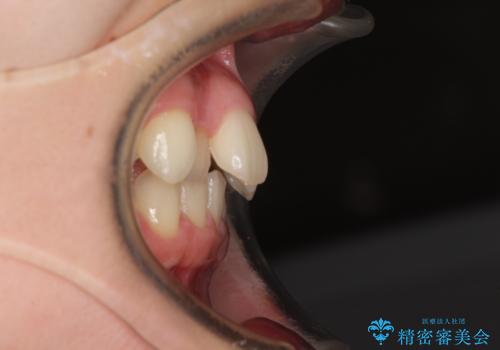 上顎のみの抜歯矯正 前歯のデコボコを改善するの治療前