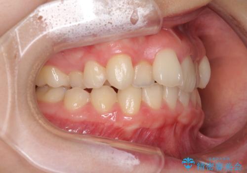 上顎のみの抜歯矯正　前歯のデコボコを改善するの治療前