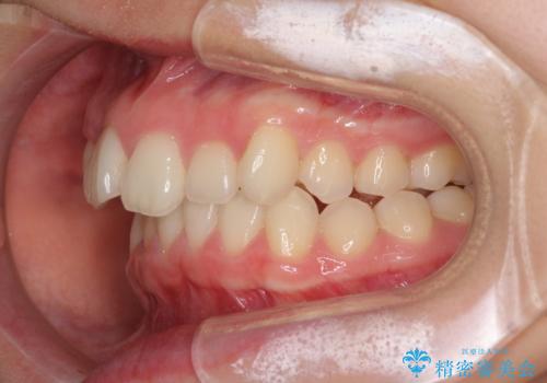 上顎のみの抜歯矯正 前歯のデコボコを改善するの治療前