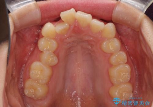 上顎のみの抜歯矯正 前歯のデコボコを改善するの治療前