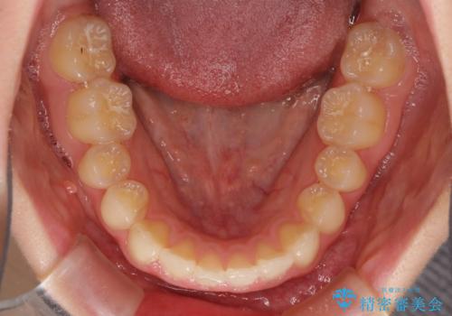 上顎のみの抜歯矯正 前歯のデコボコを改善するの治療前