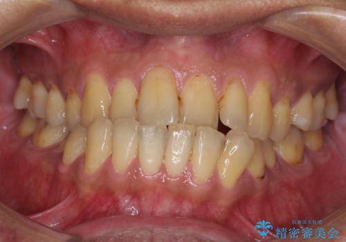 前歯のクロスバイトを改善　ワイヤー装置での非抜歯矯正の症例 治療前