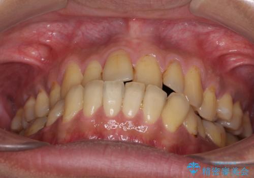 前歯のクロスバイトを改善 ワイヤー装置での非抜歯矯正の治療前