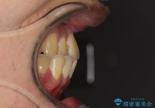 前歯のクロスバイトを改善 ワイヤー装置での非抜歯矯正の治療前