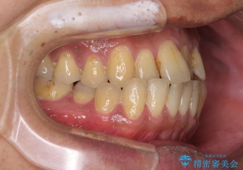前歯のクロスバイトを改善 ワイヤー装置での非抜歯矯正の治療前