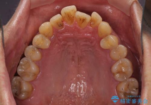 前歯のクロスバイトを改善 ワイヤー装置での非抜歯矯正の治療前