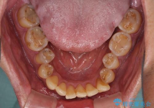 前歯のクロスバイトを改善　ワイヤー装置での非抜歯矯正の治療前